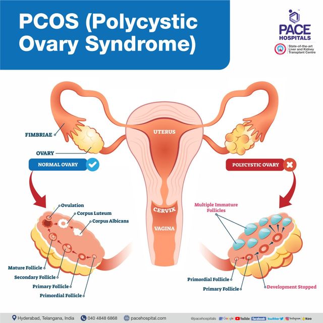 Pcod And Pcos: Causes, Symptoms, Differences And Treatment